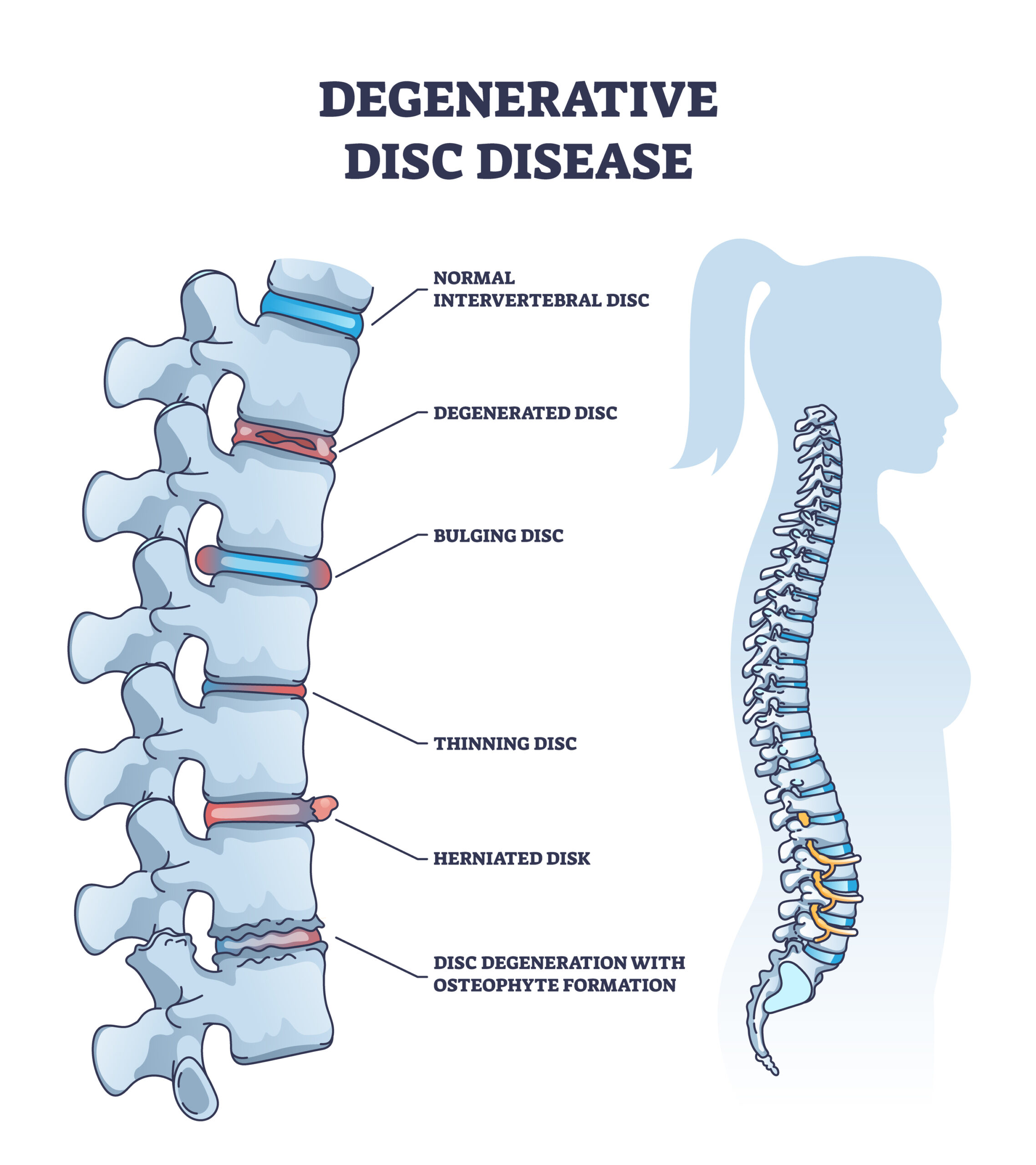 Degenerative Disc Disease With Spine And Vertebra Trauma Outline